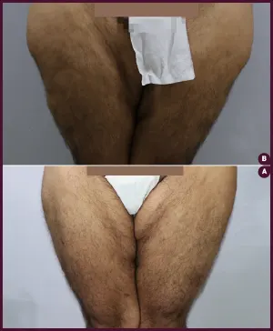 female thigh huge liposuction surgerycost in mumbai, india