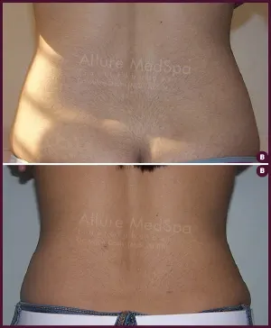 back fat male liposuction surgery at Best Cost by Dr. Milan Doshi