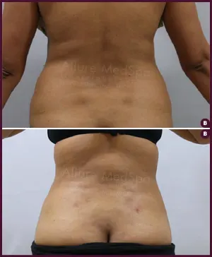 back fat female liposuction Surgery Hospitals in By Dr.Milan Doshi