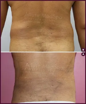 Male back fat liposuction surgery in india at Best Cost