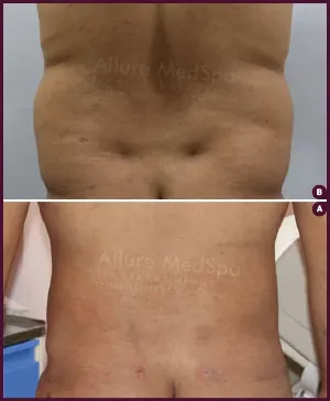 back fat liposuction surgery by Dr. Milan Doshi