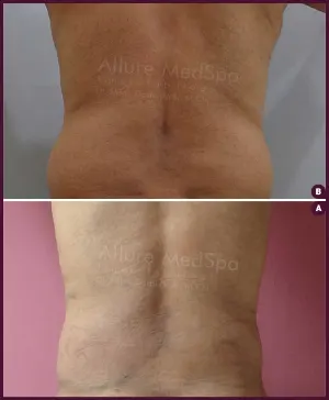back fat liposuction surgery with affordable cost mumbai By Dr.Milan Doshi