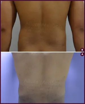 back fat vaser liposuction surgery In mumbai at Best Cost