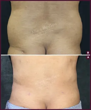 Male back fat liposuction from alure Medspa In mumbai at Best Cost