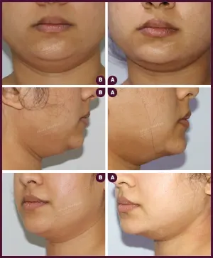 double chin female liposuction In mumbai at Best Cost by Dr.Milan Doshi