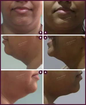 double chin female liposuction surgery at Best Cost by Dr. Milan Doshi in Mumbai