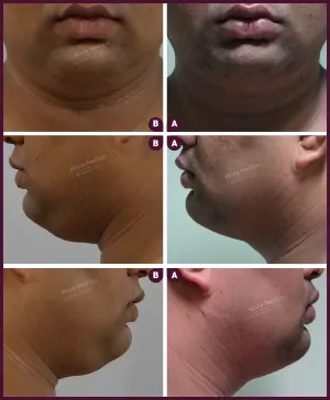 double chin male liposuction surgery from alure Medspa In mumbai at Best Cost