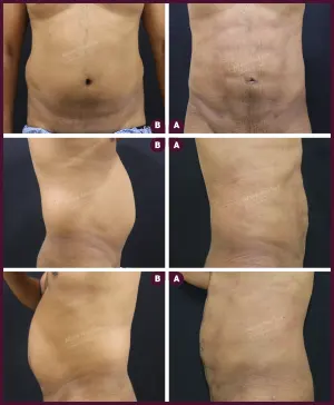 six pack abs liposuction surgery with affordable cost mumbai