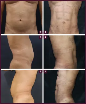 six pack abs liposuction surgery in mumbai at Allure Medspa by Milan Doshi
