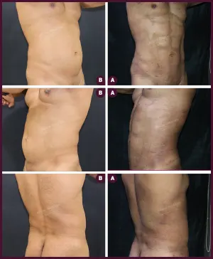 six pack abs liposuction surgery in india from alure Medspa In mumbai at Best Cost