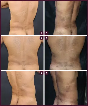 six pack abs liposuction surgery best doctor by Milan Doshi