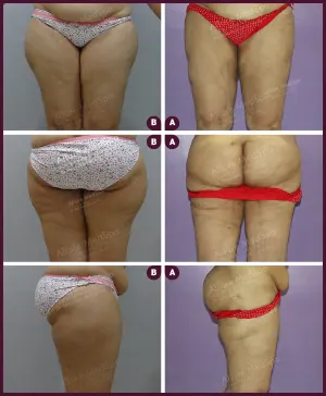 large female thigh liposuction In mumbai at Best Cost
