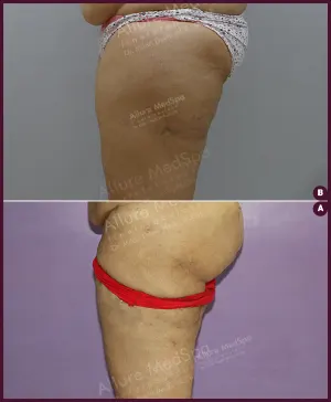 female large thigh liposuction surgery in India