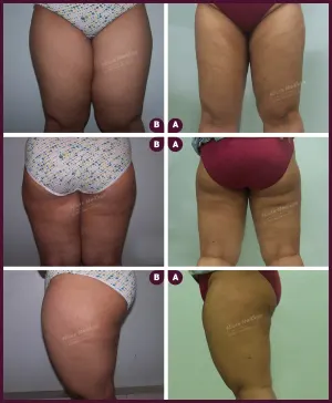 large female thigh liposuction surgery from alure Medspa In mumbai at Best Cost