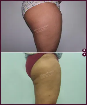female large thigh liposuction In mumbai at Best Cost