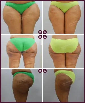 female large thigh liposuction surgery in Mumbai at Best Cost by Dr. Milan Doshi