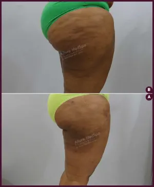 female large thigh liposuction surgery cost in India from alure Medspa In mumbai at Best Cost