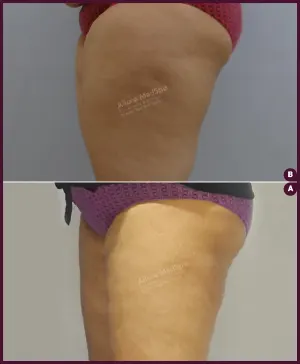 large Female Liposuction thigh surgery by Dr. Milan Doshi In Mumbai India