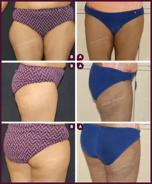 medium female thigh liposuction surgery from alure Medspa In mumbai at Best Cost