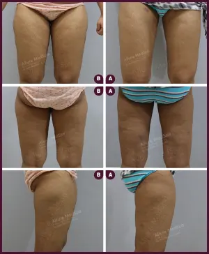 medium female thigh liposuction surgery Get the cost of Liposuction in Mumbai city hospitals