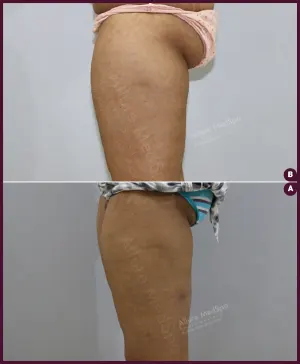 female medium thigh liposuction in Mumbai By Best docter In mumbai at Best Cost