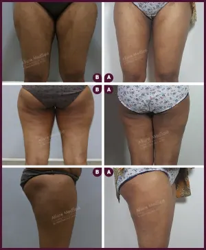 female medium thigh liposuction surgery in Mumbai