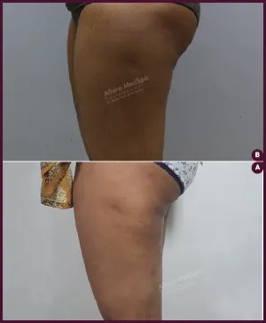 female medium thigh liposuction surgery cost in India