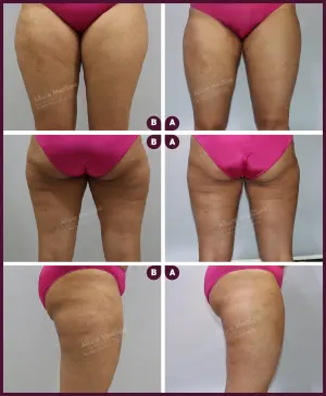 female medium thigh liposuction surgery in India