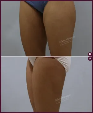 female small thigh liposuction surgery in India In mumbai at Best Cost