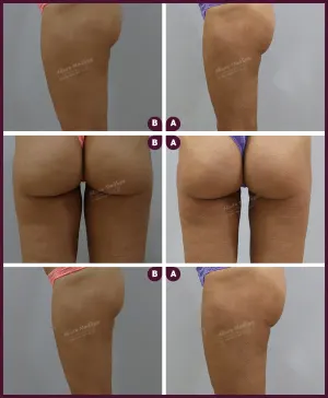 small female thigh liposuction at Best Cost by Dr. Milan Doshi in Mumbai