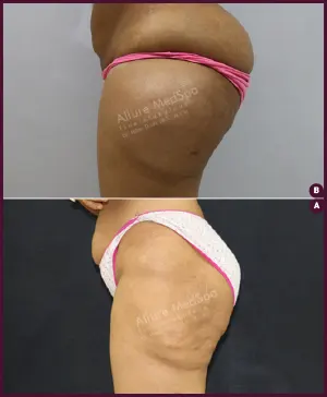 huge female thigh liposuction surgery at Best Cost by Dr. Milan Doshi in Mumbai India