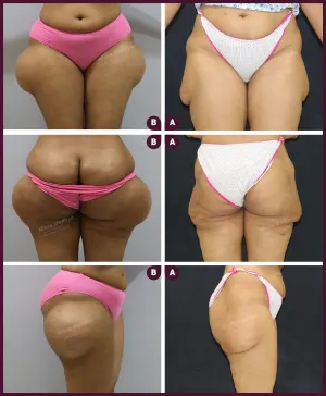 huge female thigh liposuction By Best docter Dr.Milan Doshi in Mumbai India