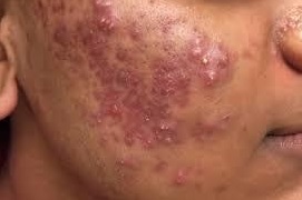 Acne can be extremely distressing at any age