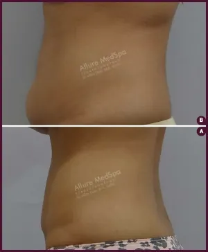Female Abdomen Small liposuction surgery In Mumbai by Dr.milan Doshi