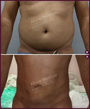 male large abdomen liposuction surgery price in Mumbai