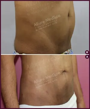 male medium abdomen liposuction surgery best doctor in mumbai