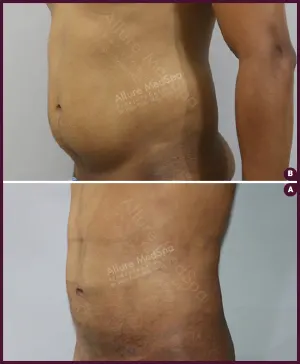 male small abdomen liposuction in India Coorection By Dr. Milan Doshi In Mumbai
