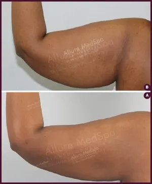 large arm female liposuction in India Done by Dr. Milan Doshi In Mumbai