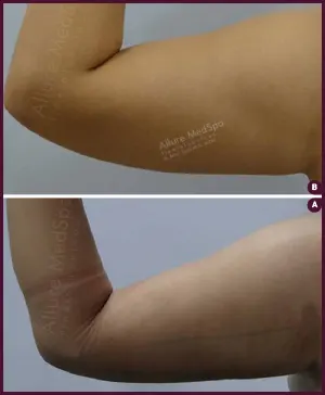 medium arm female liposuction cost Done by Dr. Milan Doshi In Mumbai