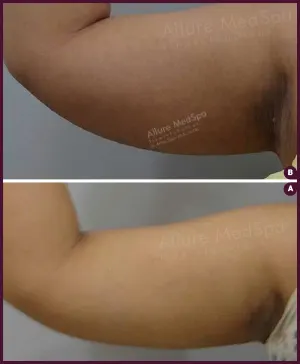 medium arm female liposuction surgery in India