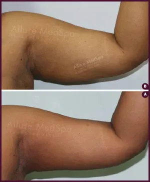 medium arm female liposuction best cost