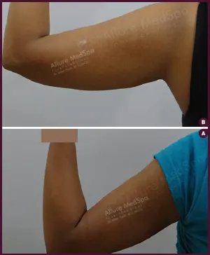 thin arm female liposuction cost in Mumbai