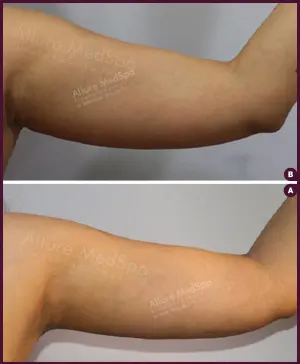 thin arm female liposuction surgery doctor Done by Dr. Milan Doshi In Mumbai