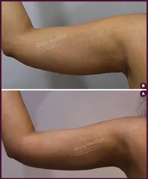 thin arm female liposuction cost in mumbai Done by Dr. Milan Doshi In Mumbai