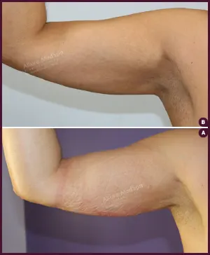 Male arm liposuction