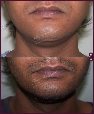 double chin male liposuction surgery in India