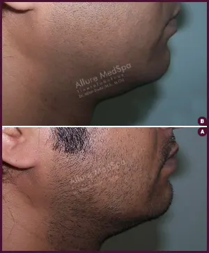 double chin male liposuction surgery cost Done by Dr. Milan Doshi In Mumbai