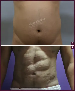 six pack abs liposuction surgery cost Coorection By Dr. Milan Doshi In Mumbai