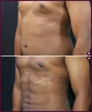 six pack vaser liposuction surgery cost in india Done by Dr. Milan Doshi In Mumbai