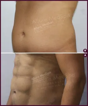 six pack abs vaser 4d liposuction surgery cost